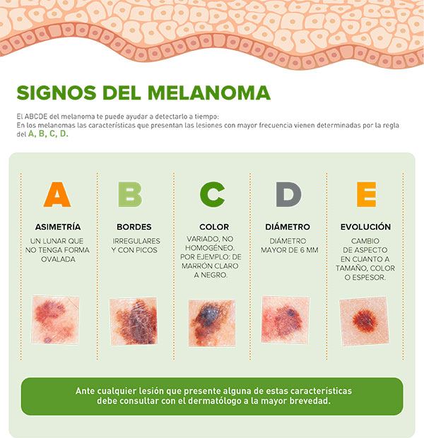 Características del Melanoma