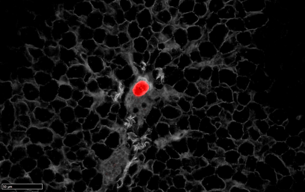 En rojo una célula tumoral de cáncer colorrectal residual extendiéndose a través de una vena
