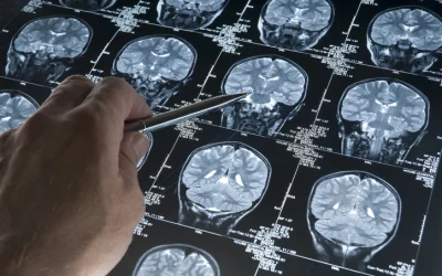 Los grandes retos de la investigación en tumores cerebrales